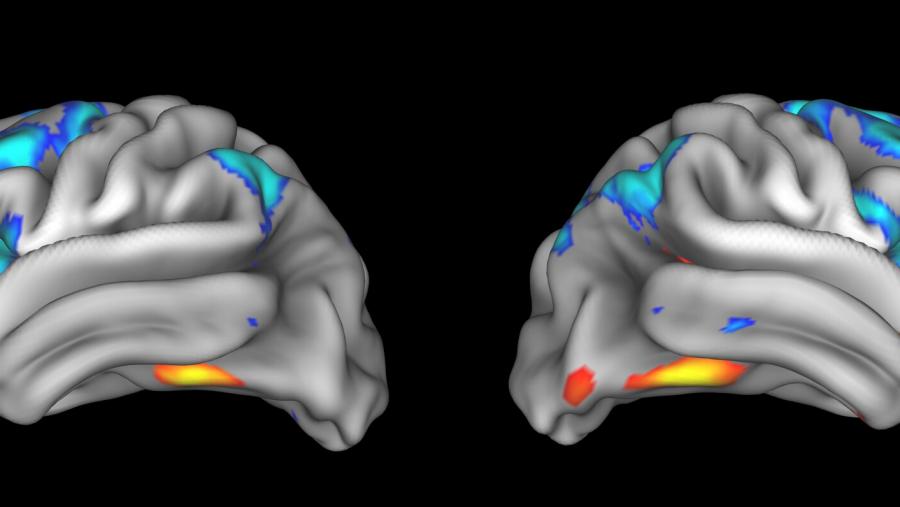MRI of Adolescent Brain