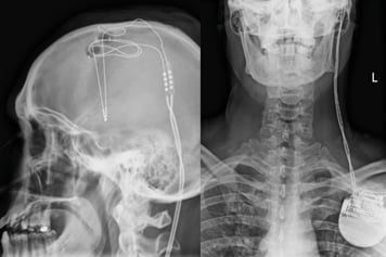 The brain wire (left) is connected to a pacemaker in the chest (right) that can both stimulate and record electrical activity.